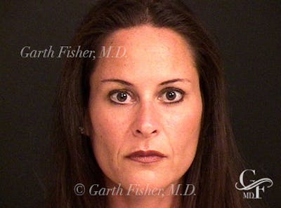 Primary Rhinoplasty Before & After Gallery - Patient 414739 - Image 2