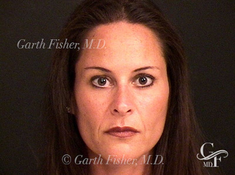 Primary Rhinoplasty Before & After Gallery - Patient 414739 - Image 2