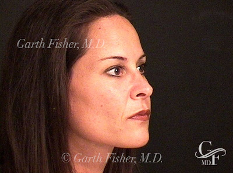 Primary Rhinoplasty Before & After Gallery - Patient 414739 - Image 4