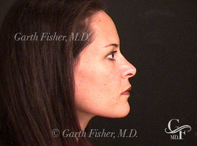 Primary Rhinoplasty Before & After Gallery - Patient 414739 - Image 6