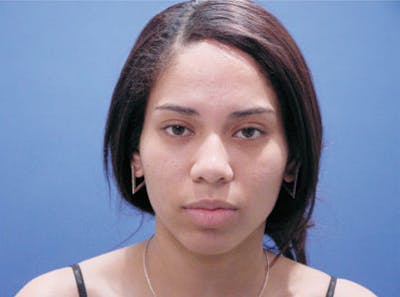 Ethnic Rhinoplasty Before & After Gallery - Patient 155270 - Image 1