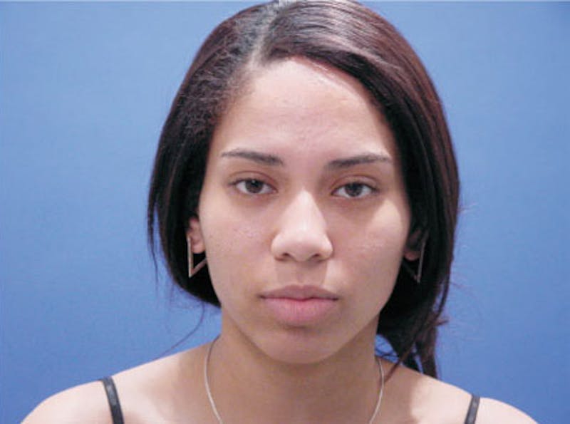 Ethnic Rhinoplasty Before & After Gallery - Patient 155270 - Image 1