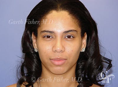 Primary Rhinoplasty Before & After Gallery - Patient 378311 - Image 2