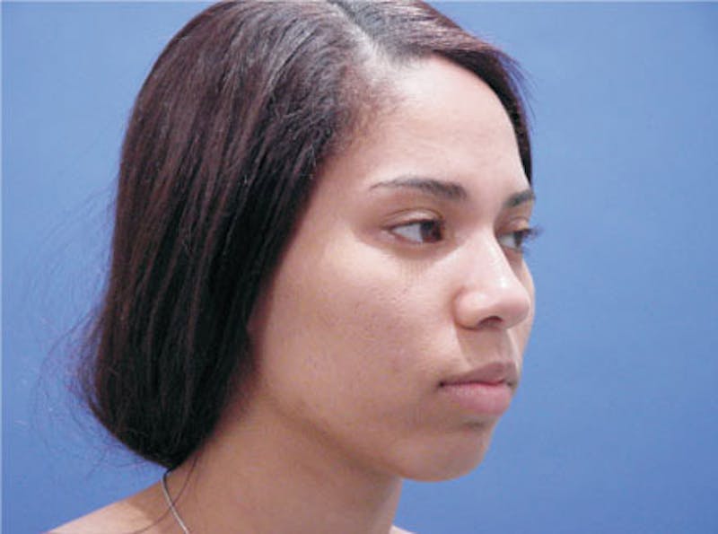 Ethnic Rhinoplasty Before & After Gallery - Patient 155270 - Image 3