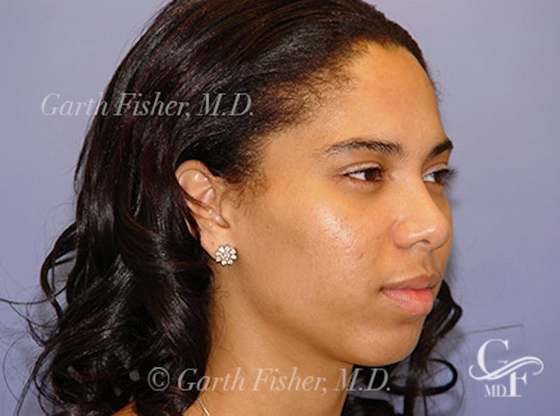 Primary Rhinoplasty Before & After Gallery - Patient 378311 - Image 4
