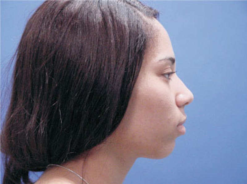 Ethnic Rhinoplasty Before & After Gallery - Patient 155270 - Image 5