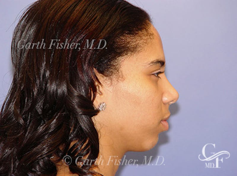 Primary Rhinoplasty Before & After Gallery - Patient 378311 - Image 6