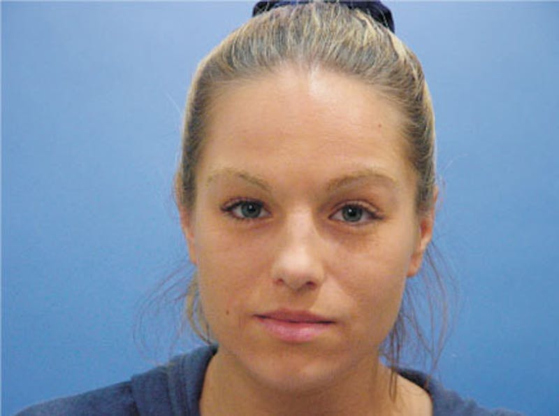 Primary Rhinoplasty Before & After Gallery - Patient 633409 - Image 1