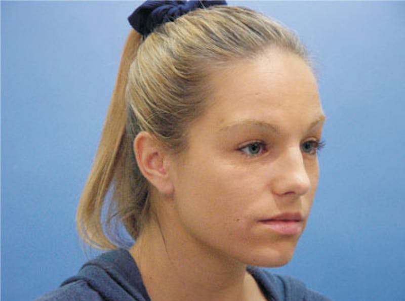 Primary Rhinoplasty Before & After Gallery - Patient 633409 - Image 3
