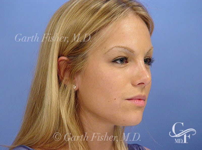 Primary Rhinoplasty Before & After Gallery - Patient 633409 - Image 4