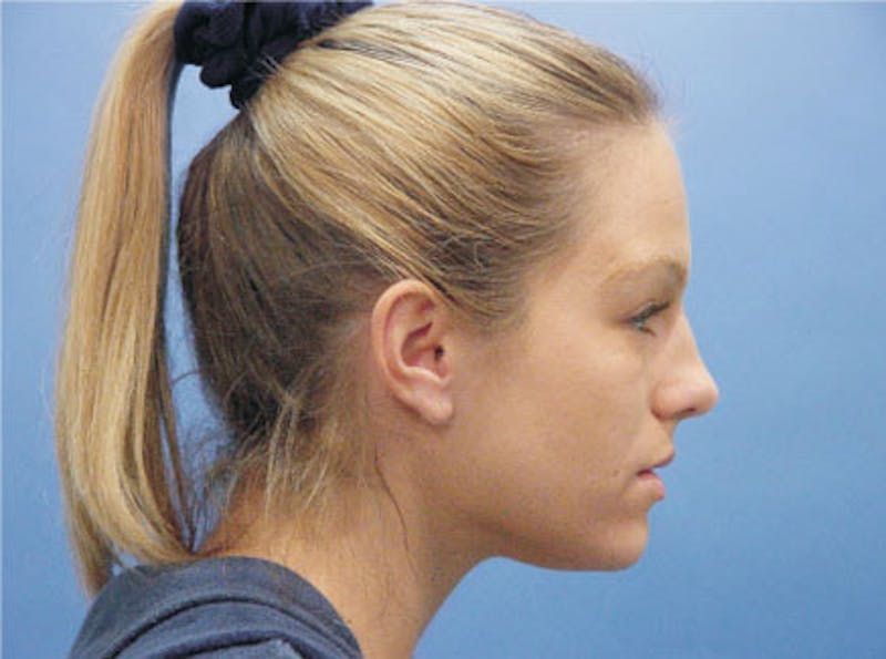 Primary Rhinoplasty Before & After Gallery - Patient 633409 - Image 5