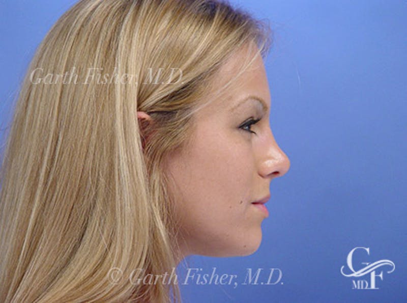 Primary Rhinoplasty Before & After Gallery - Patient 633409 - Image 6