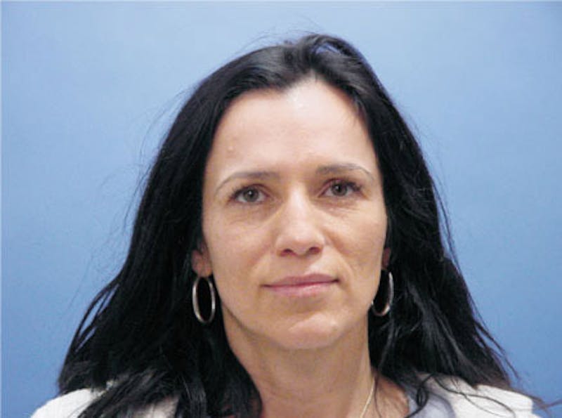 Primary Rhinoplasty Before & After Gallery - Patient 169536 - Image 1