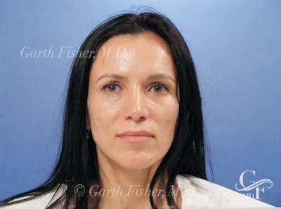 Primary Rhinoplasty Before & After Gallery - Patient 169536 - Image 2