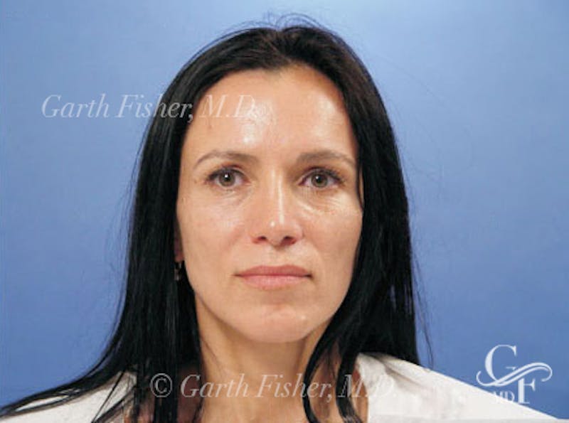 Primary Rhinoplasty Before & After Gallery - Patient 169536 - Image 2