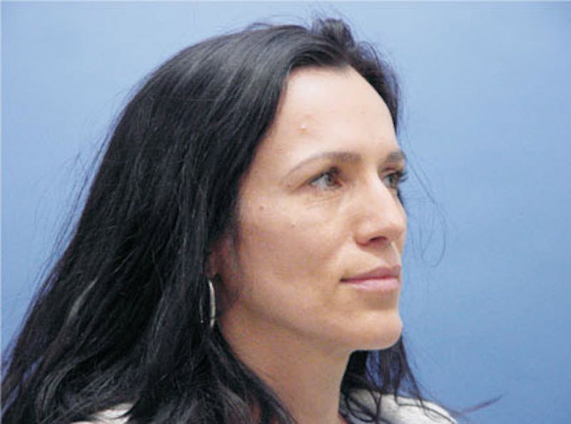 Primary Rhinoplasty Before & After Gallery - Patient 169536 - Image 3