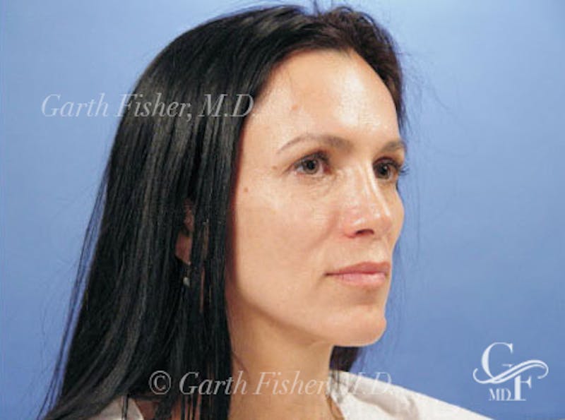 Primary Rhinoplasty Before & After Gallery - Patient 169536 - Image 4