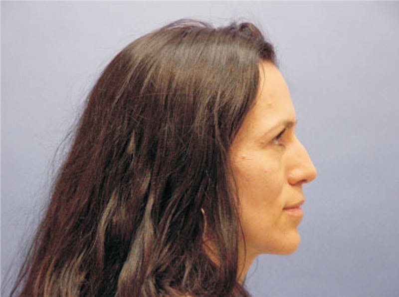 Primary Rhinoplasty Before & After Gallery - Patient 169536 - Image 5