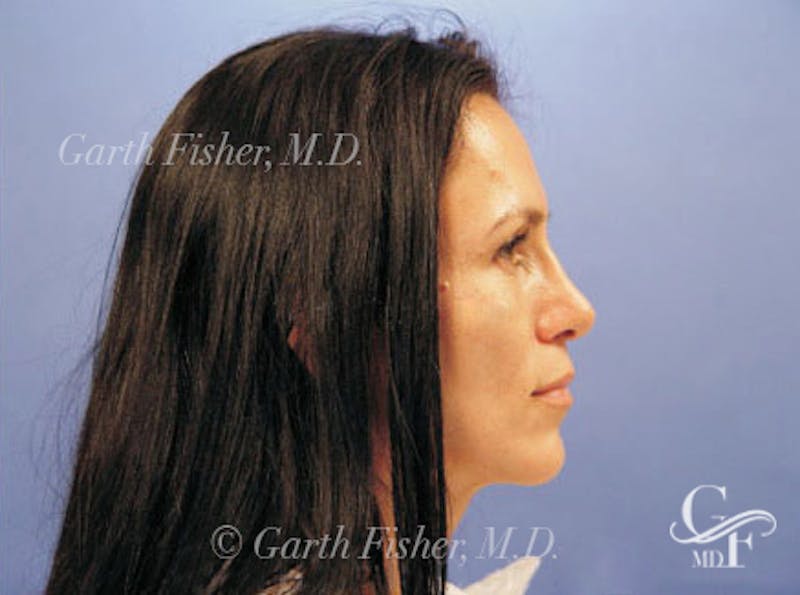 Primary Rhinoplasty Before & After Gallery - Patient 169536 - Image 6