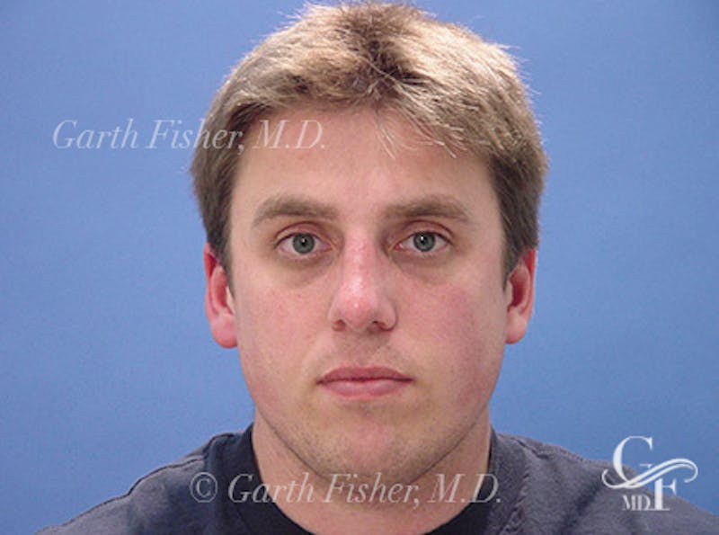 Primary Rhinoplasty Before & After Gallery - Patient 124719 - Image 2
