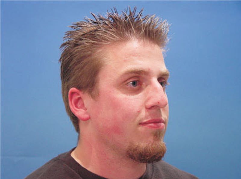 Primary Rhinoplasty Before & After Gallery - Patient 124719 - Image 3