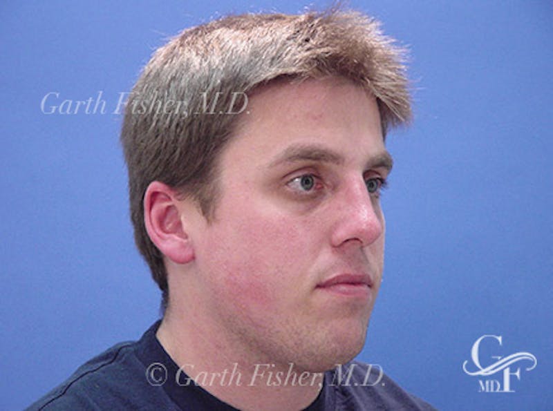Primary Rhinoplasty Before & After Gallery - Patient 124719 - Image 4