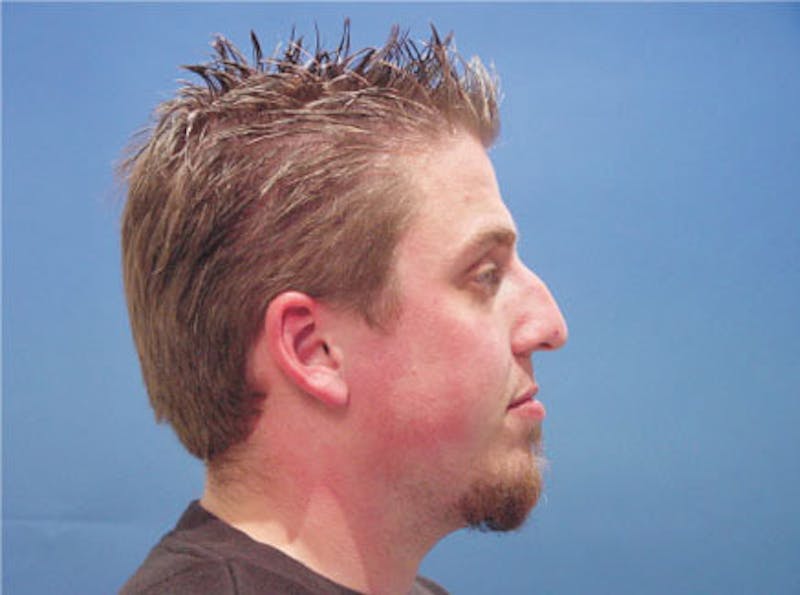 Primary Rhinoplasty Before & After Gallery - Patient 124719 - Image 5