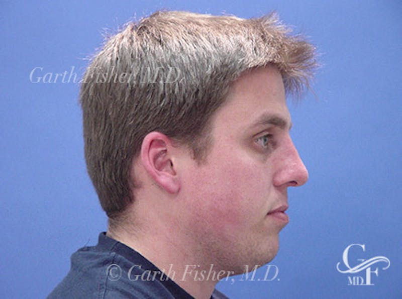 Primary Rhinoplasty Before & After Gallery - Patient 124719 - Image 6