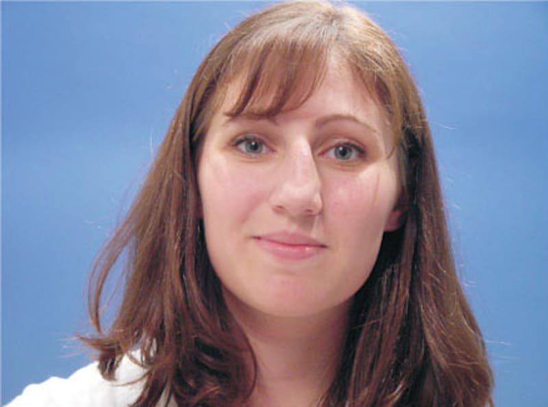 Primary Rhinoplasty Before & After Gallery - Patient 200958 - Image 1