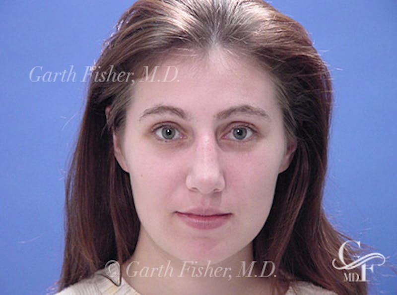 Primary Rhinoplasty Before & After Gallery - Patient 200958 - Image 2