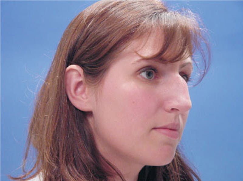 Primary Rhinoplasty Before & After Gallery - Patient 200958 - Image 3