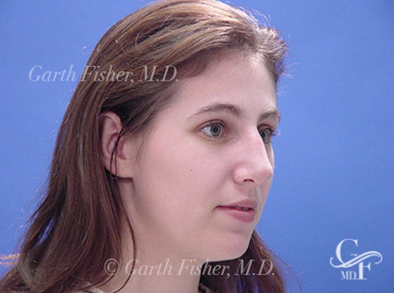 Primary Rhinoplasty Before & After Gallery - Patient 200958 - Image 4