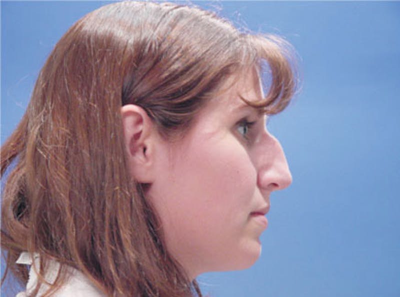 Primary Rhinoplasty Before & After Gallery - Patient 200958 - Image 5