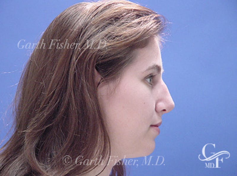 Primary Rhinoplasty Before & After Gallery - Patient 200958 - Image 6