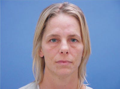 Primary Rhinoplasty Before & After Gallery - Patient 357520 - Image 1