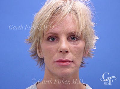 Primary Rhinoplasty Before & After Gallery - Patient 357520 - Image 2