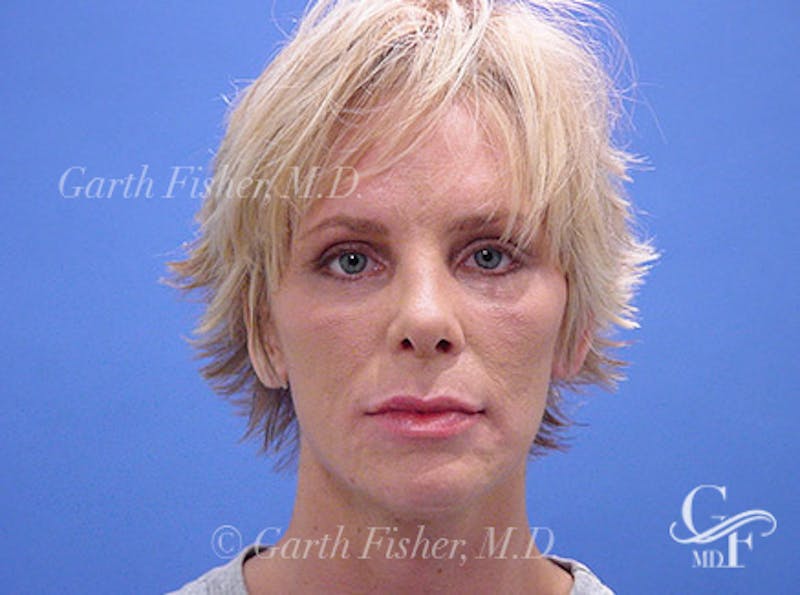 Primary Rhinoplasty Before & After Gallery - Patient 357520 - Image 2