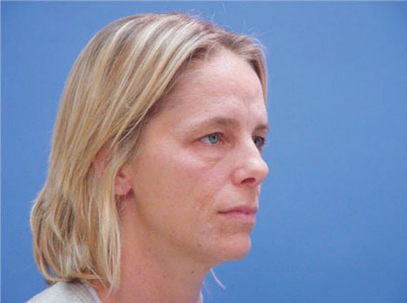 Primary Rhinoplasty Before & After Gallery - Patient 357520 - Image 3