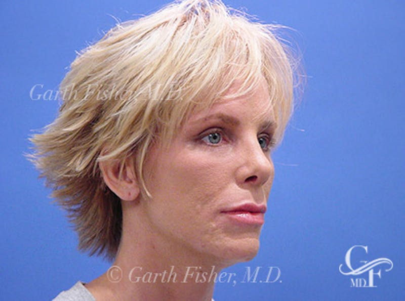 Primary Rhinoplasty Before & After Gallery - Patient 357520 - Image 4