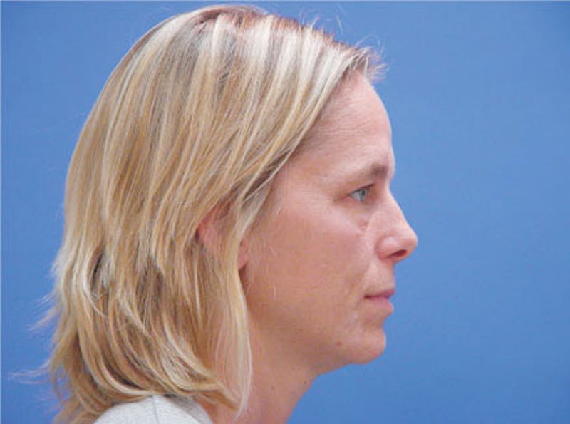 Primary Rhinoplasty Before & After Gallery - Patient 357520 - Image 5