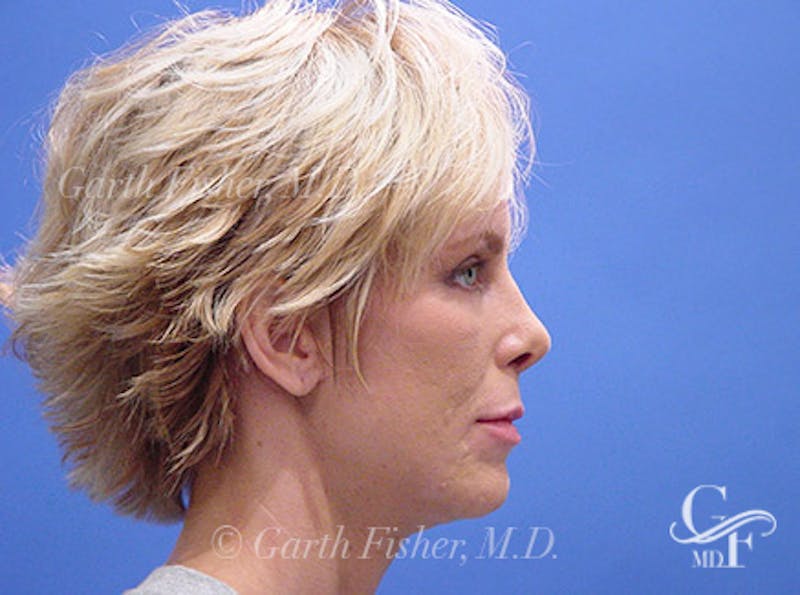 Primary Rhinoplasty Before & After Gallery - Patient 357520 - Image 6