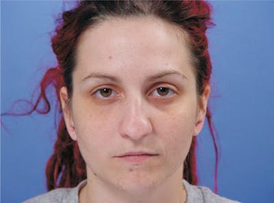 Primary Rhinoplasty Before & After Gallery - Patient 236663 - Image 1