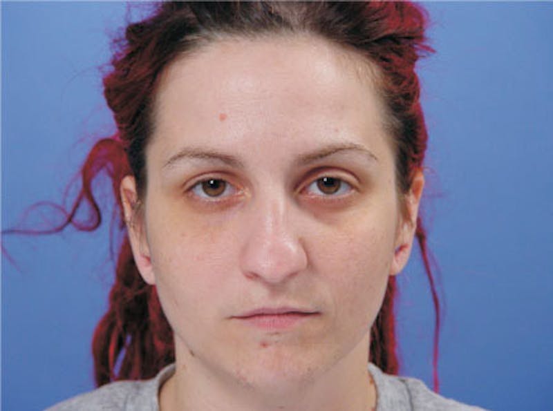 Primary Rhinoplasty Before & After Gallery - Patient 236663 - Image 1