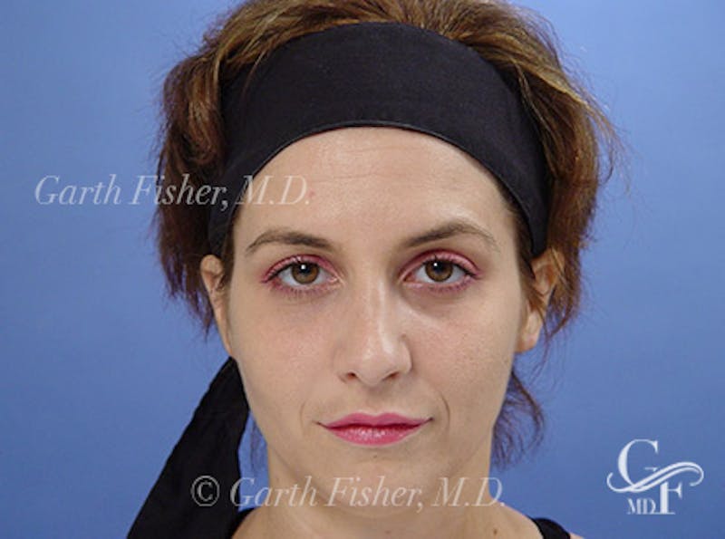 Primary Rhinoplasty Before & After Gallery - Patient 236663 - Image 2