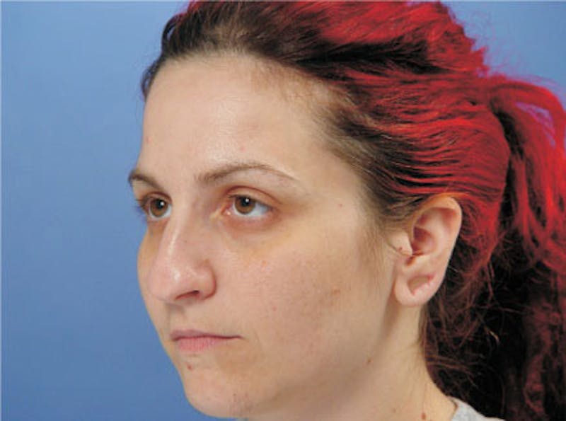Primary Rhinoplasty Before & After Gallery - Patient 236663 - Image 3
