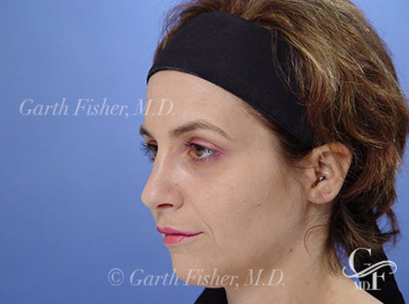 Primary Rhinoplasty Before & After Gallery - Patient 236663 - Image 4