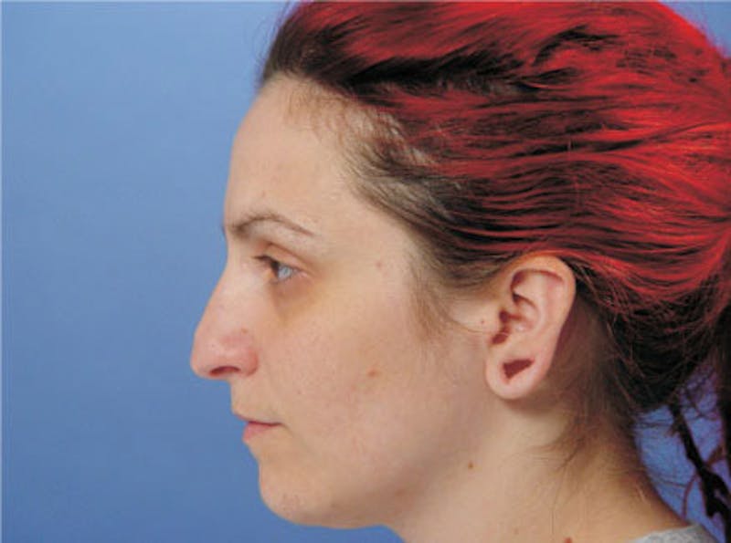 Primary Rhinoplasty Before & After Gallery - Patient 236663 - Image 5