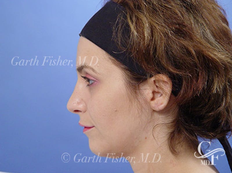 Primary Rhinoplasty Before & After Gallery - Patient 236663 - Image 6