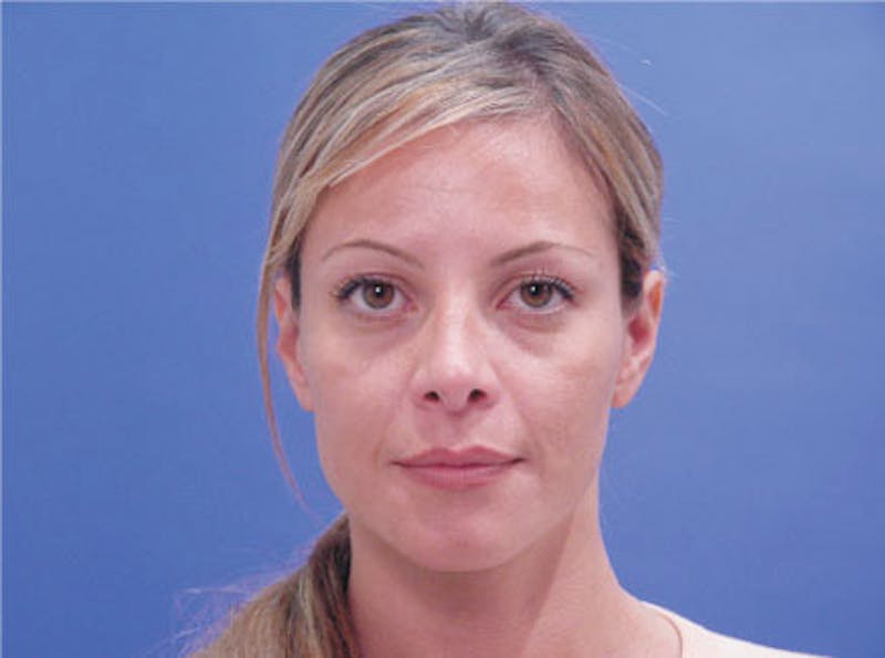 Primary Rhinoplasty Before & After Gallery - Patient 381798 - Image 1