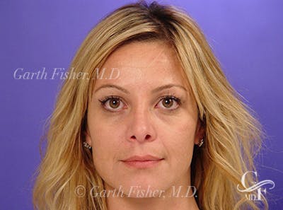 Primary Rhinoplasty Before & After Gallery - Patient 381798 - Image 2